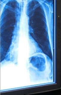 青いX線のサーマル プリンターのための乾燥した医用画像処理のフィルム11in x 17in