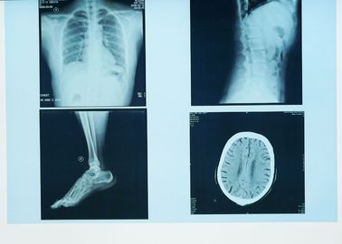 耐久X光線診断イメージ投射、32cm x 43cmの医学のペーパー レーザー青いX光線のフィルム